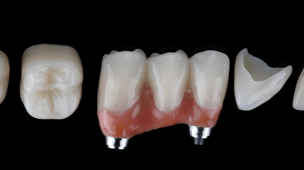 dental bridges near you