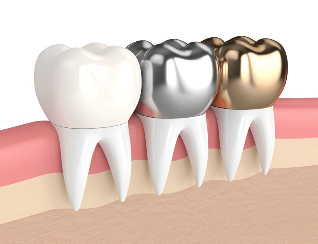 dental crowns near you