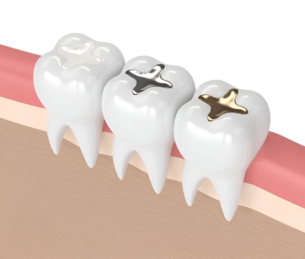 dental fillings in langley