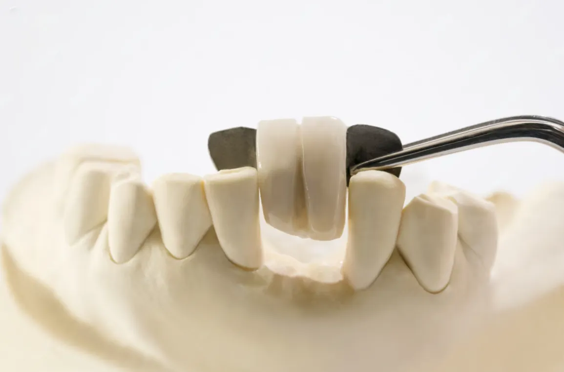 dental bridges for front teeth