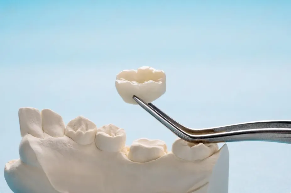 dental crown procedure step by step